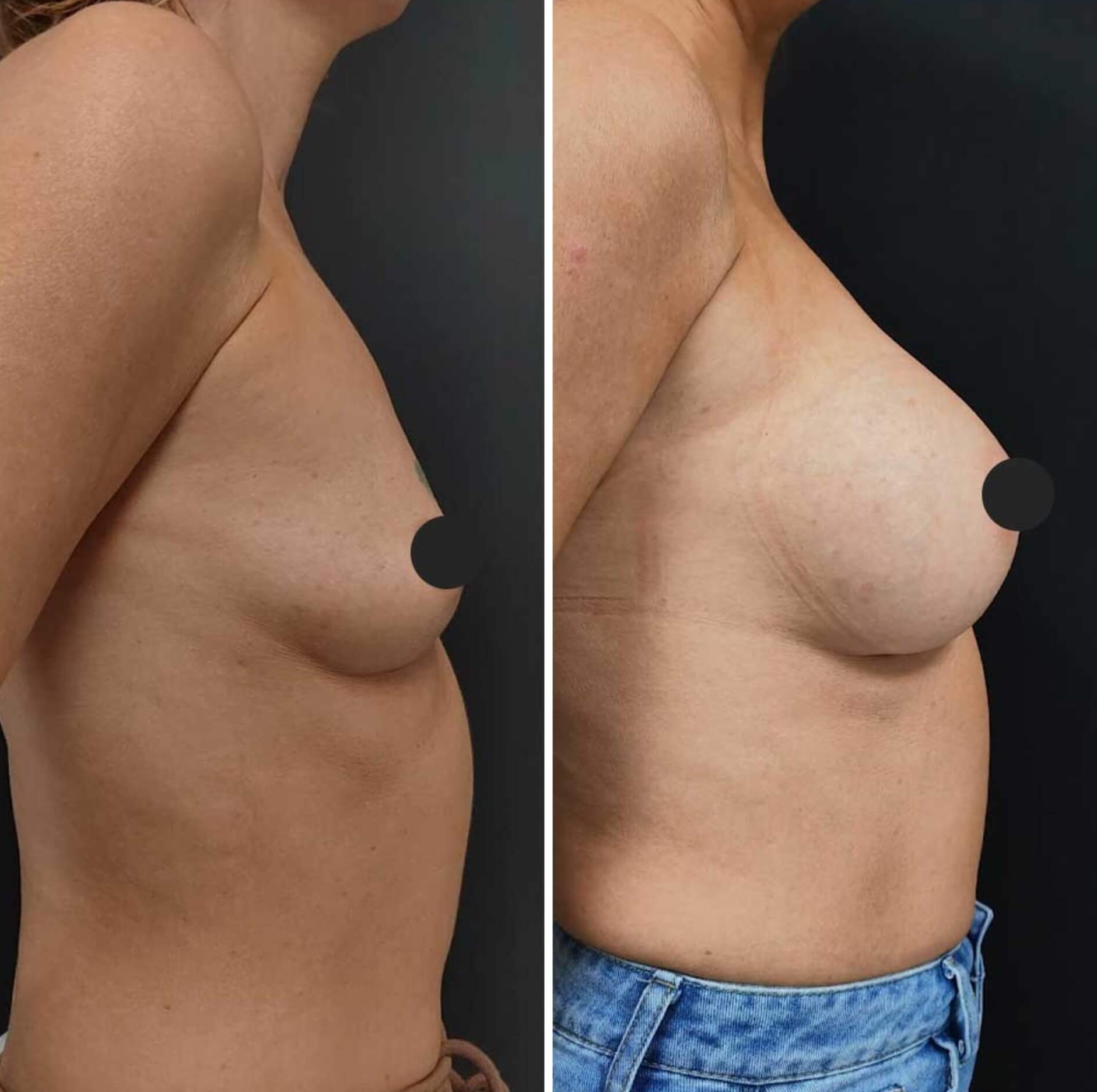 rinnaimplantaadid_breast_implant