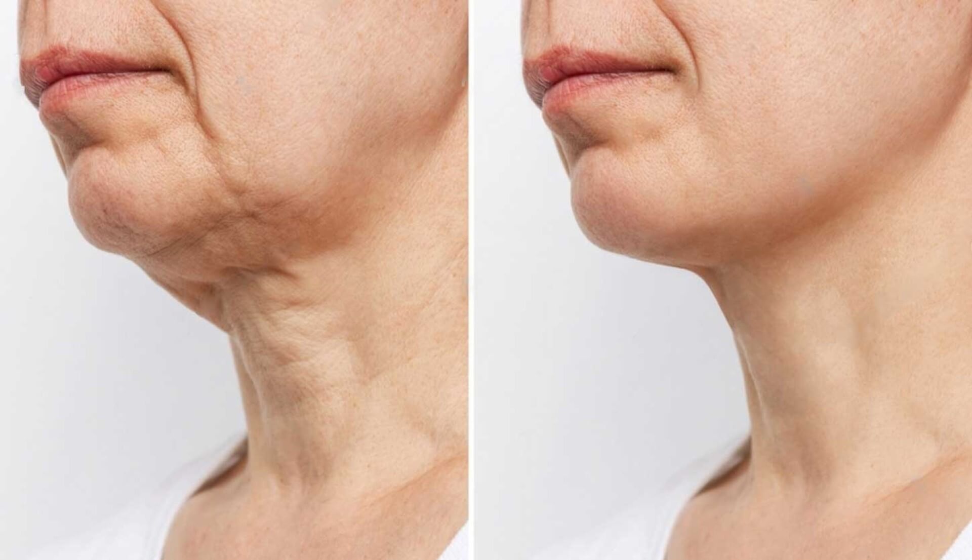 neck lift