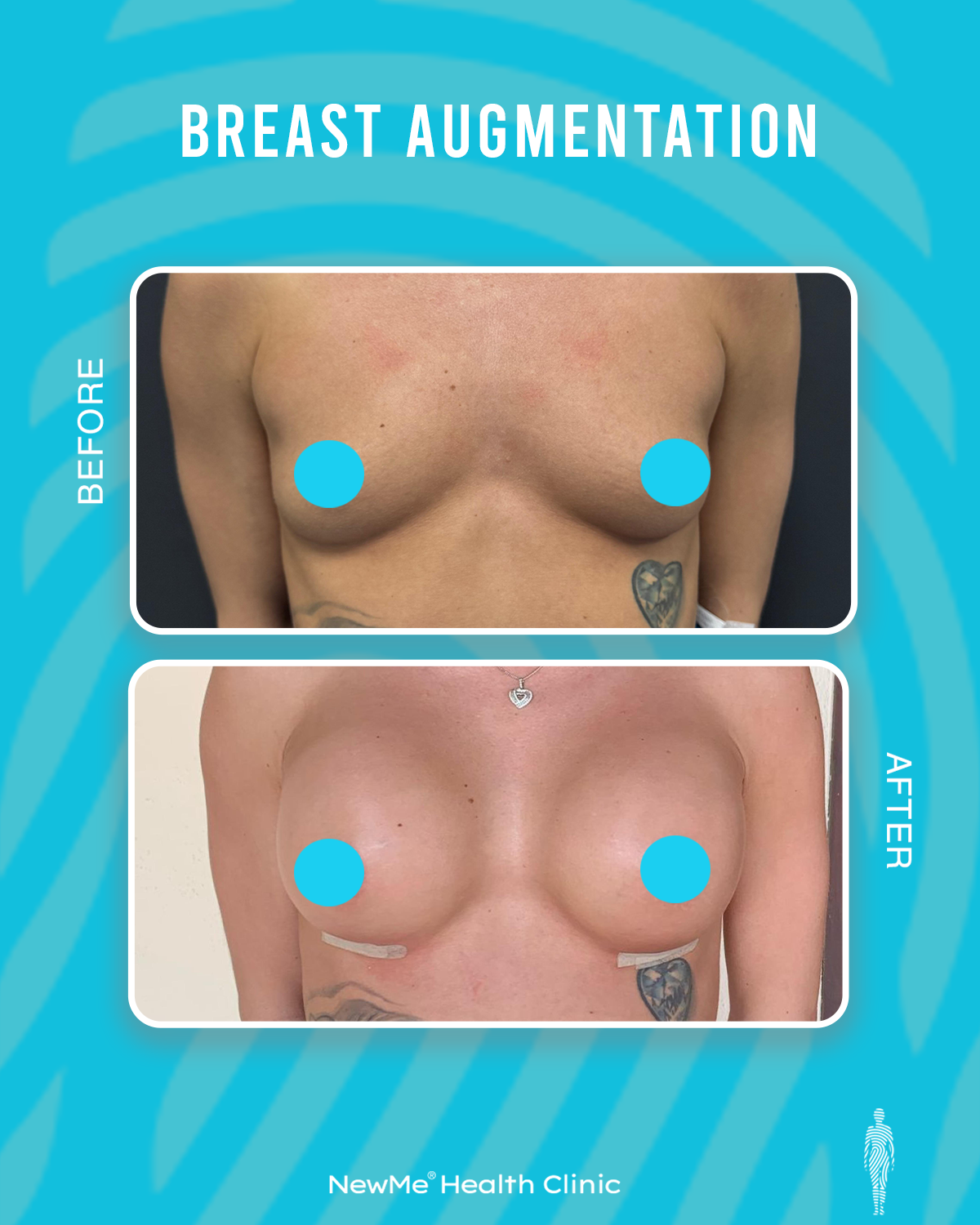 breast augmentation (1)