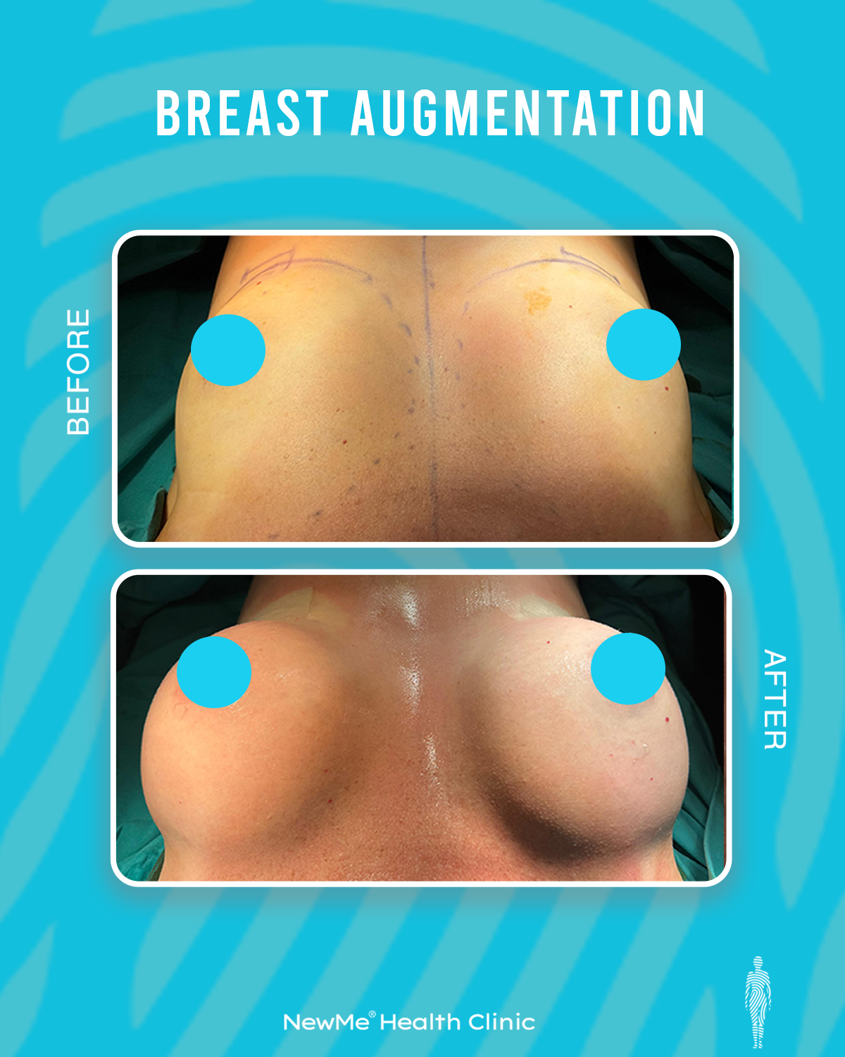 breast augmentation (2)