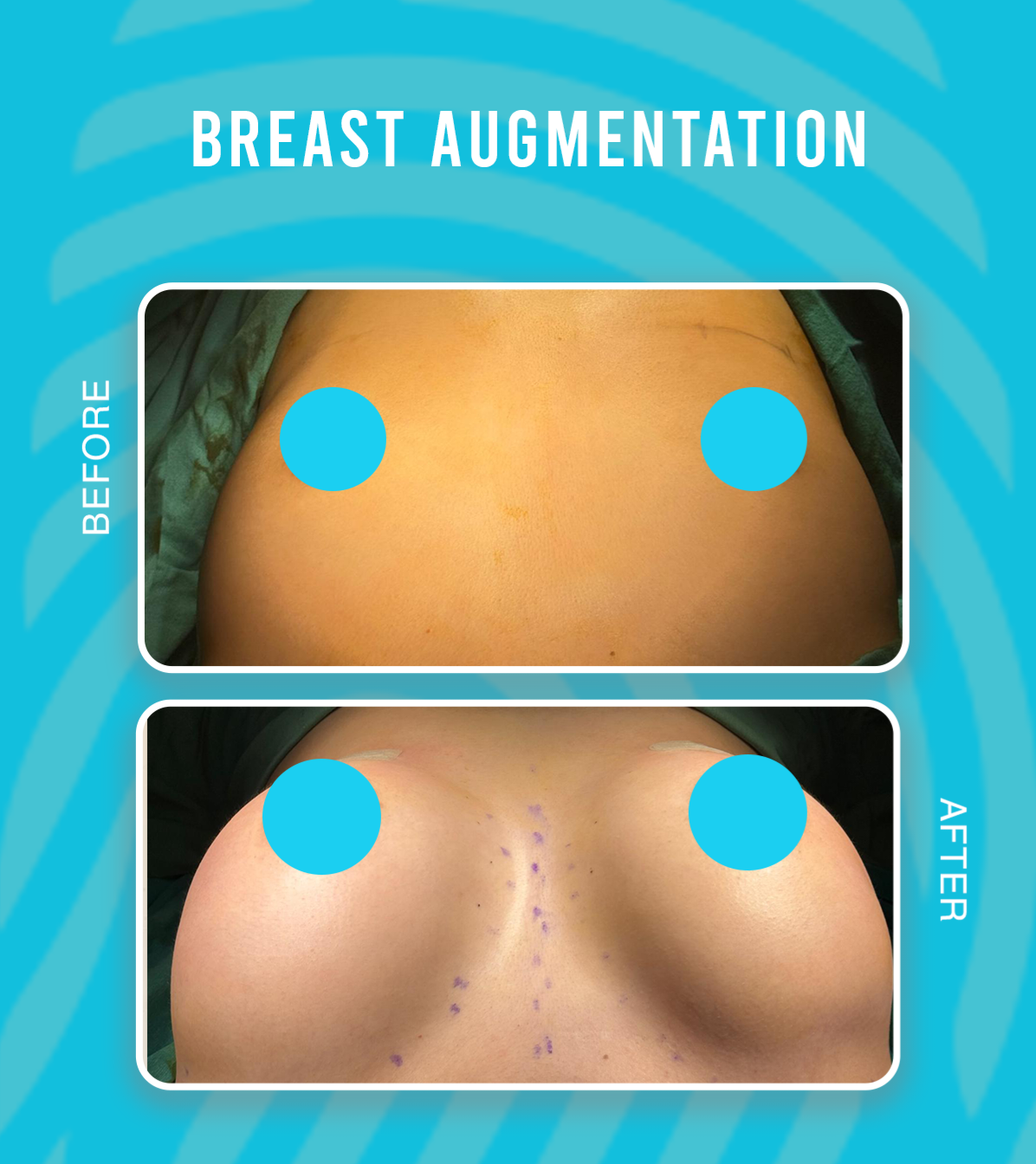 breast augmentation2 (1)