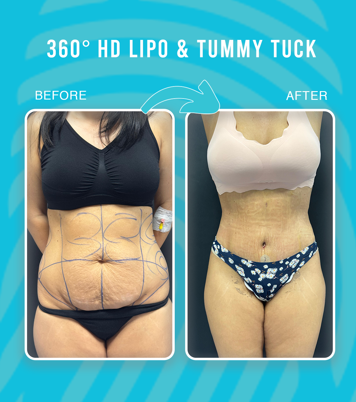 360 HD Lipo & Tummy Tuck_web