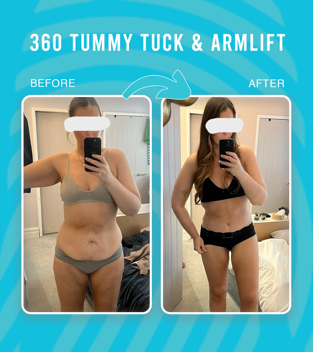 360 Tummy Tuck & Arm Lift