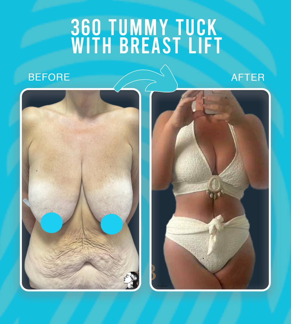360 Tummy Tuck with Breast Lift_web